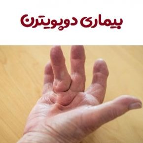 دوپویترن