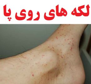 علت به وجود امدن لکه های قهوه ای روی پا چیست؟ + روش درمان