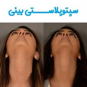 سپتوپلاستی بینی
