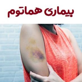 هماتوم