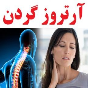 آرتروز گردن