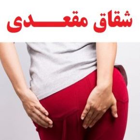 شقاق مقعدی