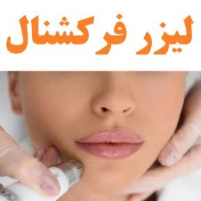 لیزر فرکشنال