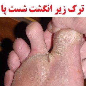 ترک زیر انگشت شست پا