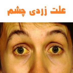 زردی چشم