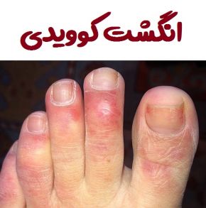 علائم انگشت کوویدی پا و خطرات جدی آن + علت