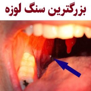 بزرگترین سنگ لوزه