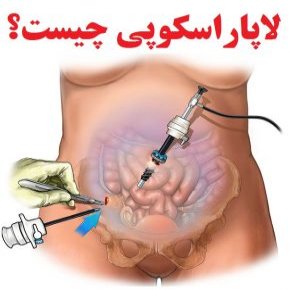 لاپاراسکوپی