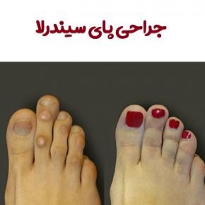 جراحی پای سیندرلا