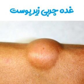 لیپوم