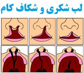 شکاف کام یا لب شکری جنین در سونوگرافی مشخص میشود؟ + نحوه جلوگیری