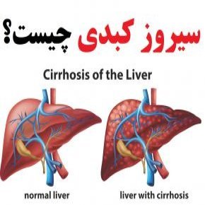 علت و علائم سیروز کبدی و درمان خانگی آن