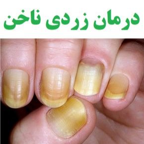 درمان زردی ناخن با نسخه های خانگی و گیاهی + علت