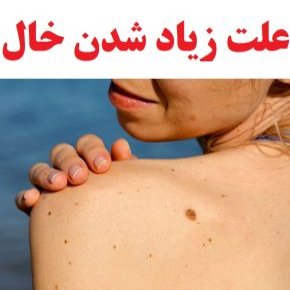 علت زیاد شدن خال