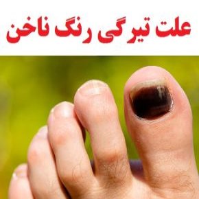 سیاه شدن ناخن و تیرگی رنگ ناخن چه دلایلی دارد؟