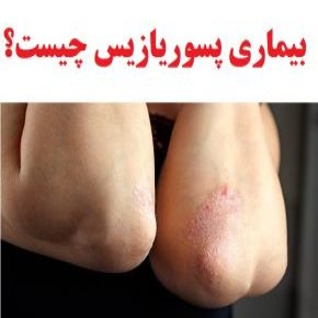 بیماری پسوریازیس یا صدف