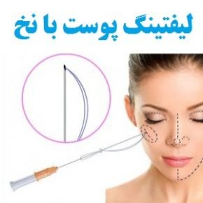 لیفتینگ پوست با نخ